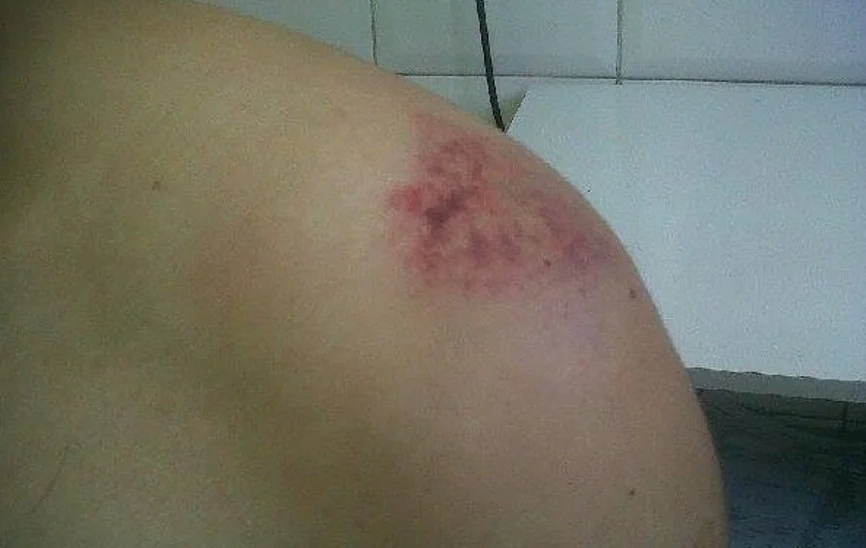 fractura