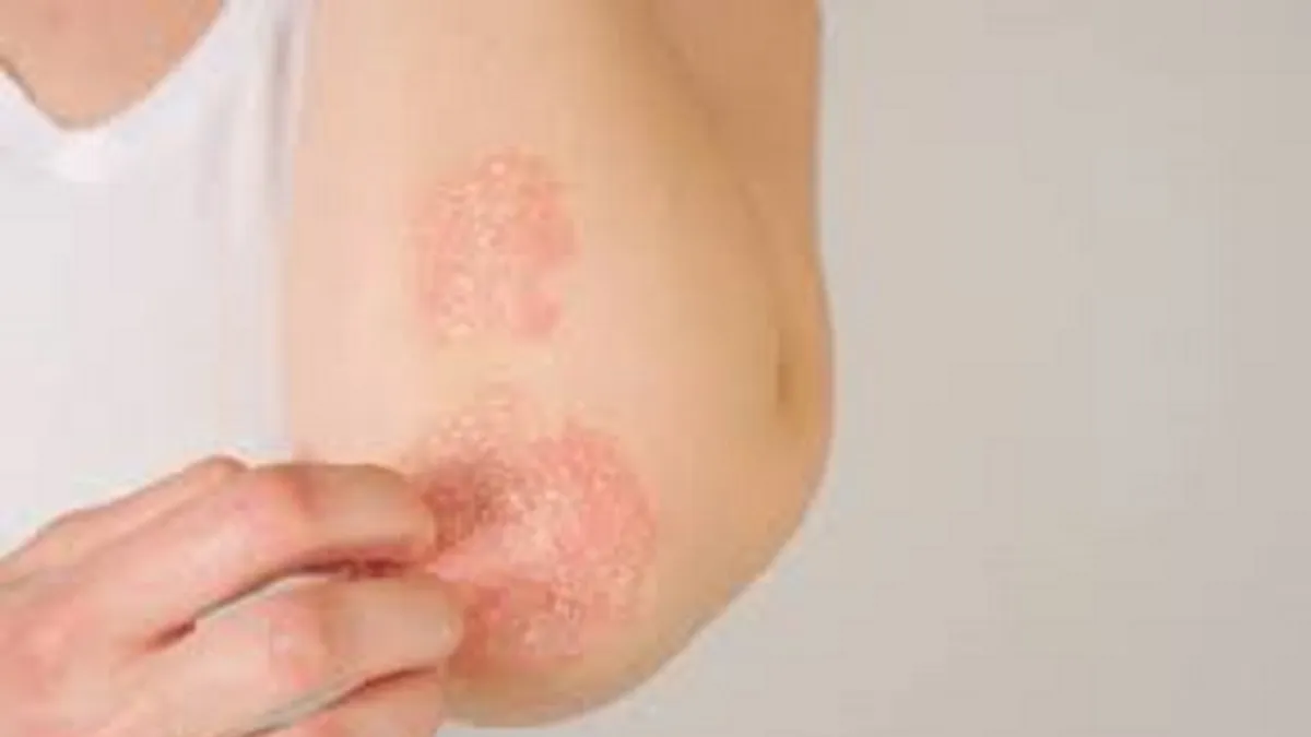Psoriasis