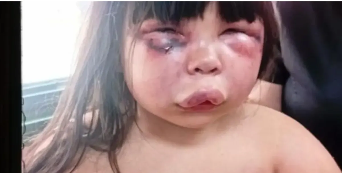 niña golpeada