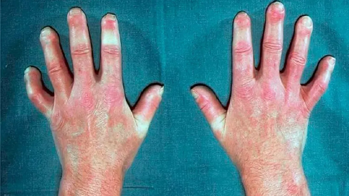 Esclerodermia