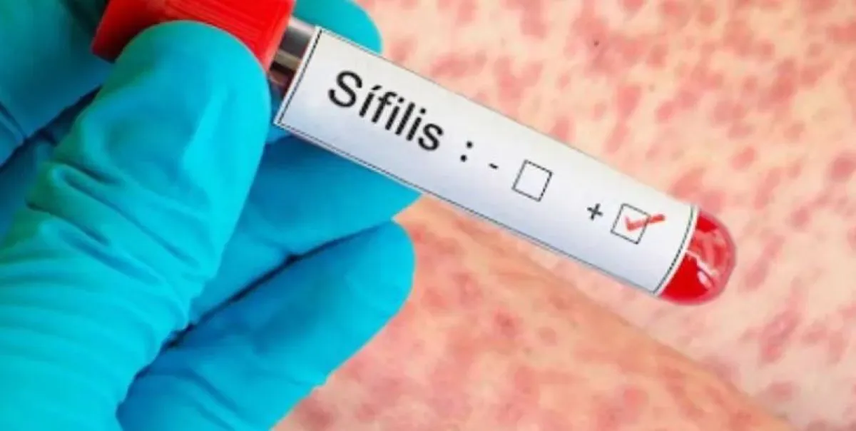 sifilis